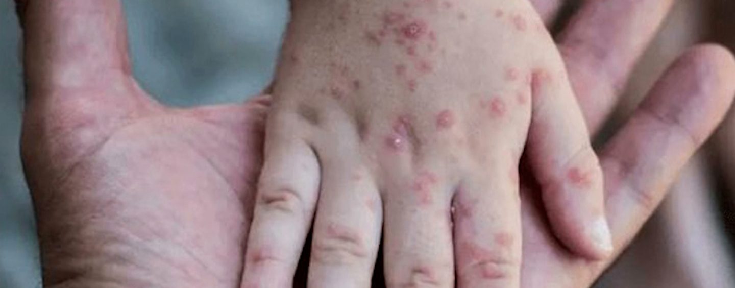 ZABILJEŽEN PRVI SLUČAJ MAJMUNSKIH BOGINJA KOD DJEVOJČICE