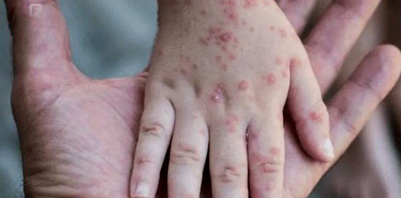 ZABILJEŽEN PRVI SLUČAJ MAJMUNSKIH BOGINJA KOD DJEVOJČICE