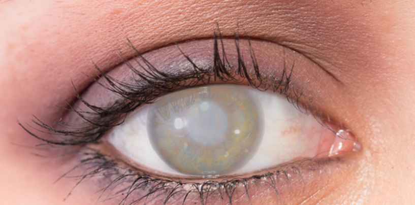 U SISKU DUGA LISTA ZA OPERACIJU SIVE MRENE